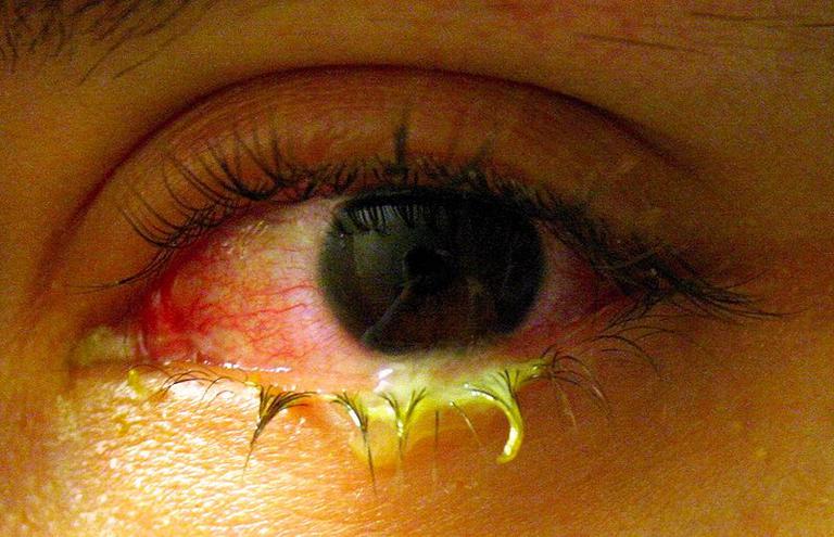 An Eye With Bacterial Conjunctivitis. Note Yellow Discharge.