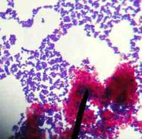 Mixed acid-fast stain  showing both Acid-fast (pink) and nonacid-fast  (purple) bacteria 1000xTM.