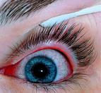 An Eye Infected With Viral Conjunctivitis