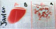 Student blood test: Three drops of blood are mixed with anti-B (left) and anti-A (right) serum. The aagglutination on the right side indicates type A blood.