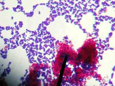 Ziehl Neelsen stain showing both acid-fast Mycobacterium (pink) and Staphylococcus (purple)
