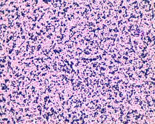 Gram stain mixed sample od Staphylococcus (Gram +, purple cocci) & E. coli, (Gram- pink rods) @ 1000xTM