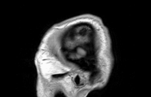MRI of Human Head